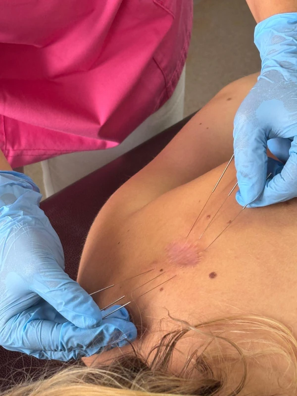 terapia blizn pooperacyjnych Warszawa